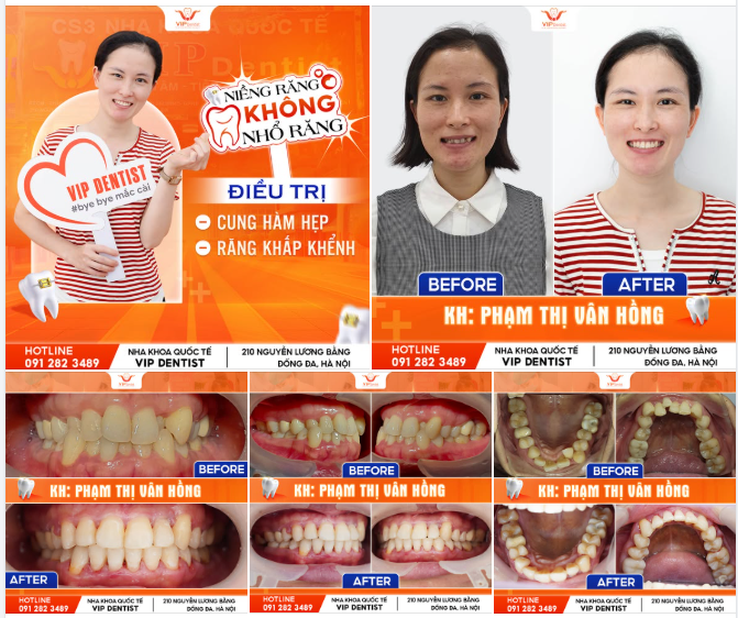 Chị Vân Hồng đã trở thành "Bigfan" của Vip Dentist sau khi niềng răng vì đã giúp chị thay đổi nụ cười nhưng vẫn bảo tồn đủ răng.
