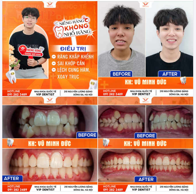 "RẤT BẤT NGỜ" - Vì em không nghĩ răng mình có thể đều đẹp thế này mà không phải nhổ răng.