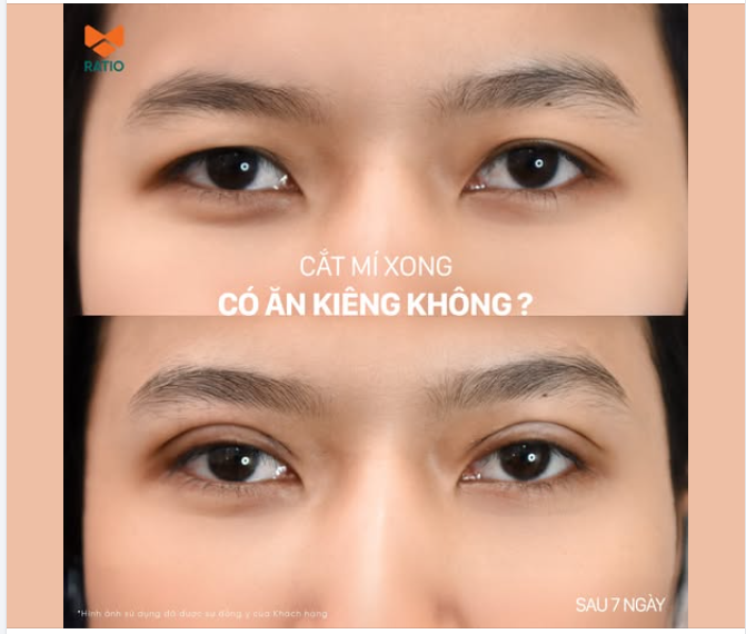 CẮT MÍ XONG CÓ CẦN KIÊNG GÌ KHÔNG?