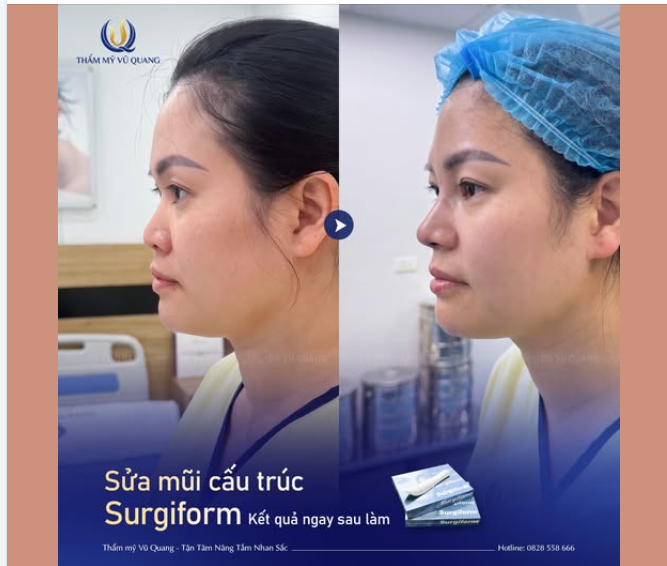 60 PHÚT SỬA MŨI CẤU TRÚC SURGIFORM VÀ CÁI KẾT!