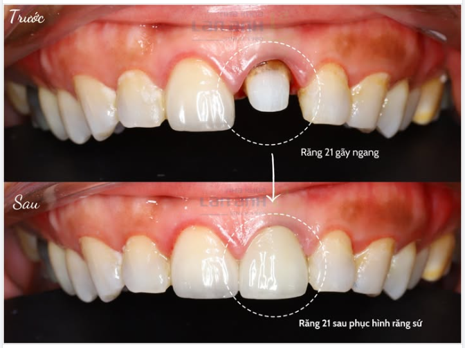 Răng 21 trước đây “ẩn thân” hơi kỹ…  Giờ đã comeback đầy tự tin rồi nha