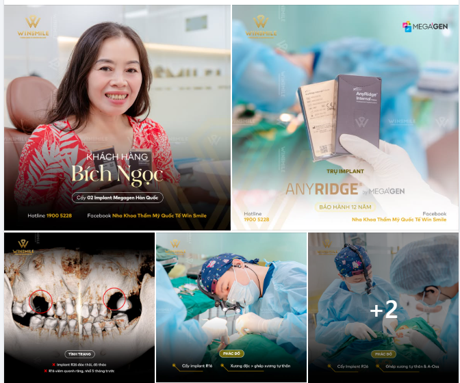 “Cô từng cấy implant ở win smile rồi, nên lần này điều trị tiếp cô thấy yên tâm lắm” - Đó là chia sẻ đầy thoải mái của cô Bích Ngọc ngay trước buổi hẹn cấy implant cùng bác sĩ Đức.
