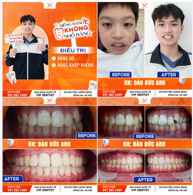 NIỀNG RĂNG GIAI ĐOẠN VÀNG - GIÚP QUÁ TRÌNH NIỀNG TỐI ƯU!