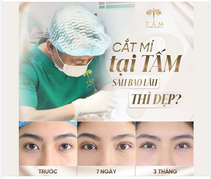 CẮT MÍ TẠI TẤM BAO LÂU THÌ ĐẸP?