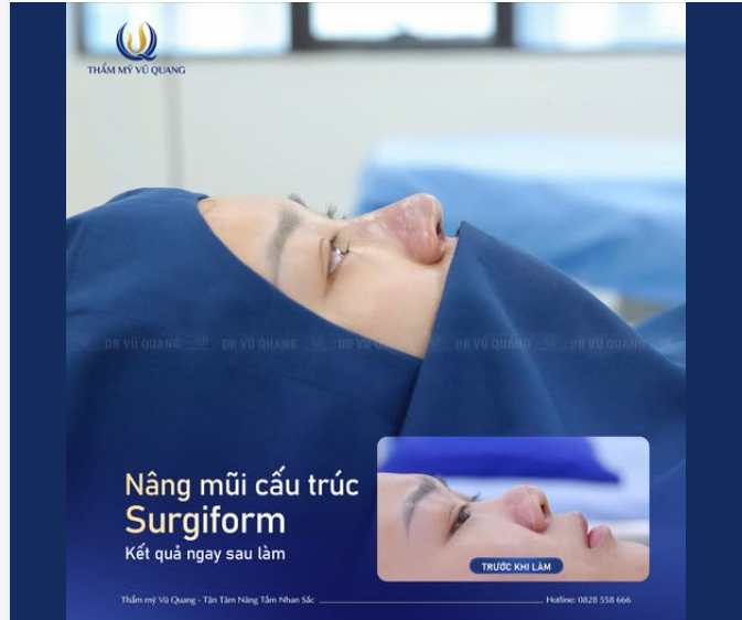 Cô gái Huế bay ra Hà Nội để nâng mũi tại Thẩm mỹ Vũ Quang