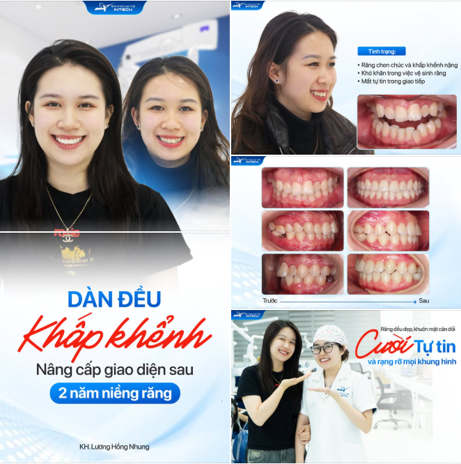 KHÁCH HÀNG HỒNG NHUNG: NIỀNG RĂNG XONG, GÓC NGHIÊNG THAY ĐỔI ĐẾN KHÔNG NGỜ!