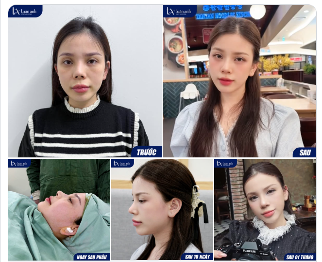 Tạm biệt sống mũi l.ệch, co rút – "Mẫn nhi" Gen Z đã sẵn sàng cho một khởi đầu mới