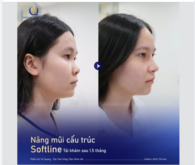 Sau hơn 1 tháng nâng mũi, bạn Q.N (2k4) đã chính thức thoát kiếp "né ống kính".