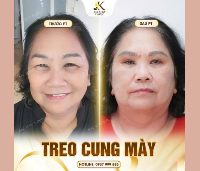 Trẻ hoá chỉ sau một lần can thiệp