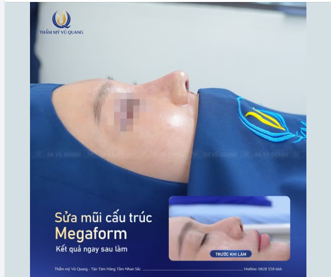 MŨI bao xơ, lệch, và lộ chất liệu  là hậu quả sau 1 lần nâng tại cơ sở không uy tín của chị K.H đến từ Phú Thọ
