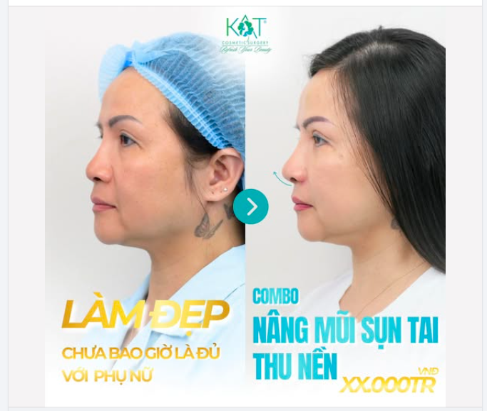 Combo nâng mũi sụn tai thu nền giúp dáng mũi thanh thoát hơn, góc nghiêng mềm mại hơn nhưng vẫn giữ nét tự nhiên riêng của mình.