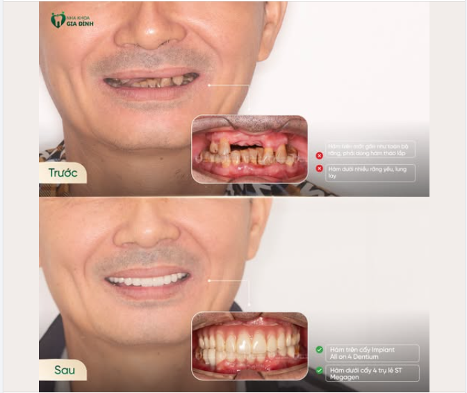 HÀNH TRÌNH TÌM LẠI NỤ CƯỜI Ở TUỔI U60 CỦA CHÚ HÀ ĐỨC KẾ