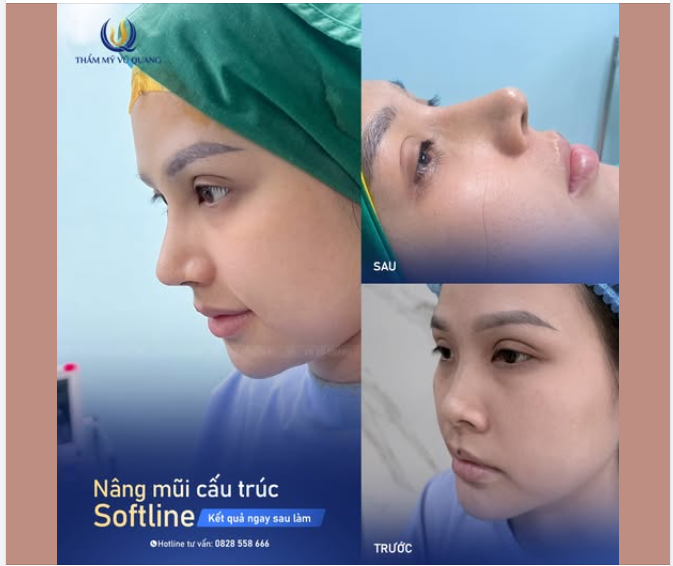 Một dáng mũi quá xuất sắc dành cho cô gái Sài Gòn