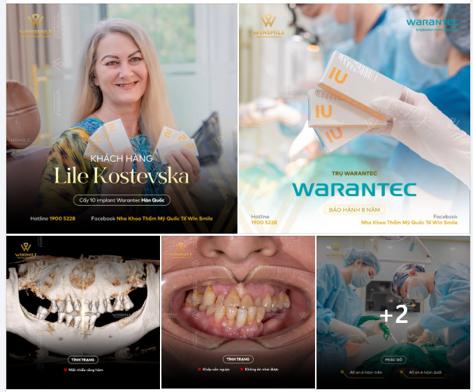MẤT RĂNG HÀM KÈM KHỚP CẮN NGƯỢC - BÀI TOÁN ĂN NHAI PHỨC TẠP ĐƯỢC KHÔI PHỤC BẰNG IMPLANT TOÀN HÀM
