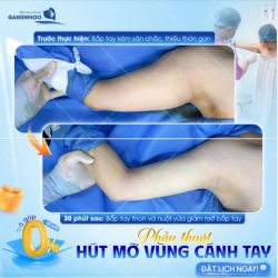 TỰ TIN DIỆN ÁO HAI DÂY VỚI CÁNH TAY THANH THOÁT