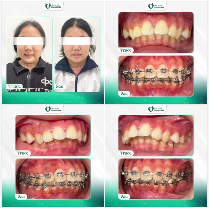 HÀNH TRÌNH NỤ CƯỜI ĐƯỢC NÂNG NIU TỪ SỚM CỦA BẢO TRÂN
