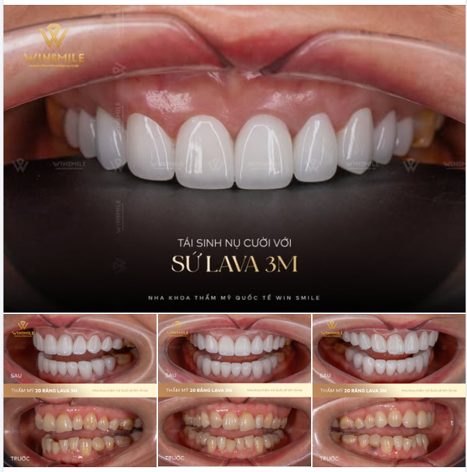 TÁI SINH NỤ CƯỜI VỚI SỨ LAVA 3M