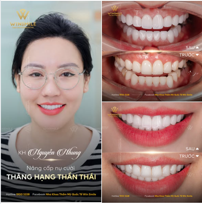 Chị Nhung đã từng làm răng sứ ở một nơi khác, nhưng sau một thời gian, chị dần cảm thấy nụ cười ấy không thuộc về mình.