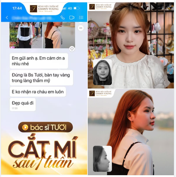 KHÔNG NHẬN RA CHÁU GÁI SAU 7 NGÀY CẮT MÍ CÙNG BÁC SĨ TƯƠI