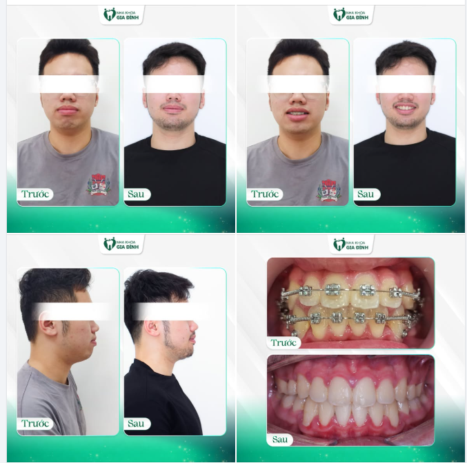 NIỀNG RĂNG ĐI - VÌ NỤ CƯỜI TỎA SÁNG