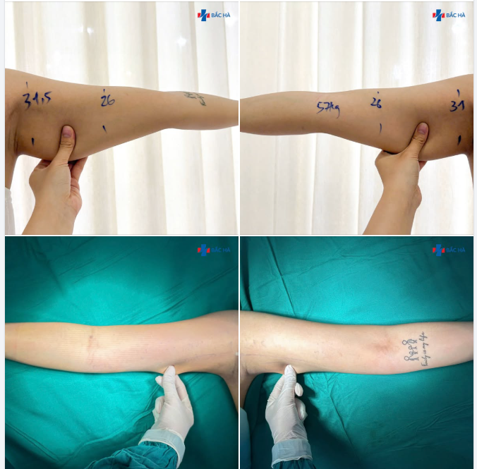 CÁNH TAY GỌN HƠN – FORM DÁNG NHÌN KHÁC HẲN SAU HÚT MỠ
