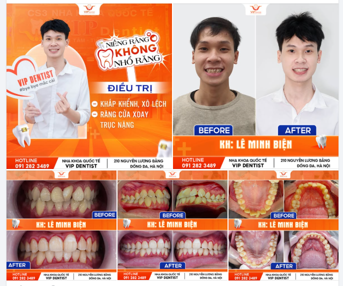 TRẢ LẠI NỤ CƯỜI "SOÁI CA" - VỚI RĂNG CỬA XOAY 90 ĐỘ