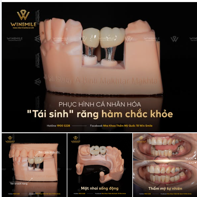 PHỤC HÌNH CÁ NHÂN HÓA “TÁI SINH” NHỮNG CHIẾC RĂNG HÀM CHẮC KHỎE
