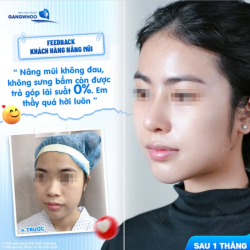 NÂNG MŨI KHÔNG ĐAU - KHÔNG SƯNG