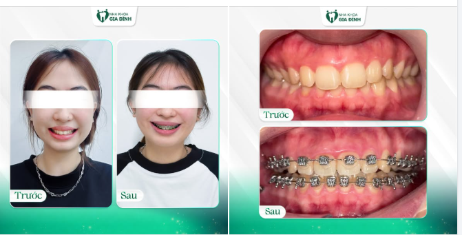 CHỈNH LẠI NỤ CƯỜI - KIẾN TẠO RẠNG NGỜI