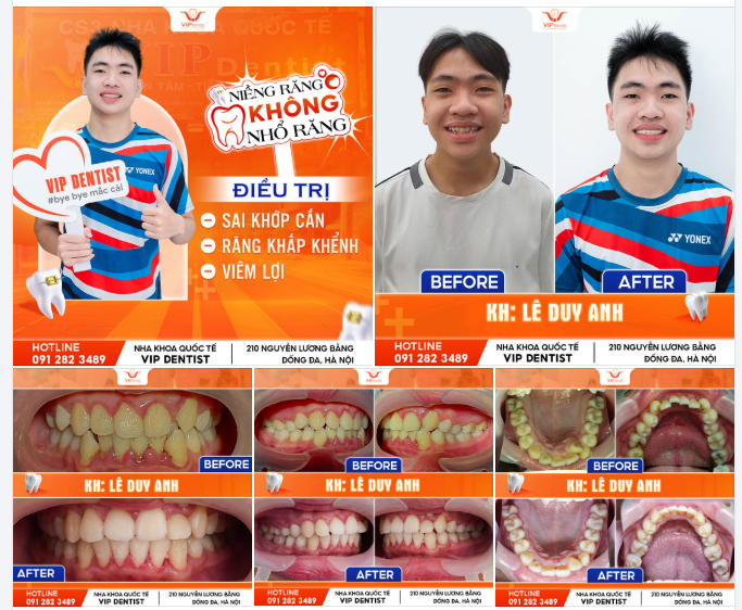 NIỀNG RĂNG LÀ QUYẾT ĐỊNH ĐÚNG ĐẮN NHẤT CỦA BẠN LÊ DUY ANH VÌ HÀM RĂNG 9630!