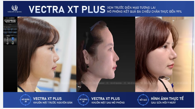Tại Thẩm mỹ Vũ Quang, khách hàng sửa mũi hỏng sẽ được trải nghiệm SIÊU CÔNG NGHỆ VECTRA XT PLUS – mô phỏng dáng mũi tương lai đa chiều chân thực đến 99%.