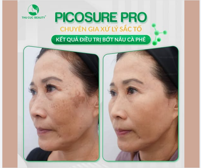 MỜ BỚT TỚI 90% CHỈ SAU 1 LIỆU TRÌNH