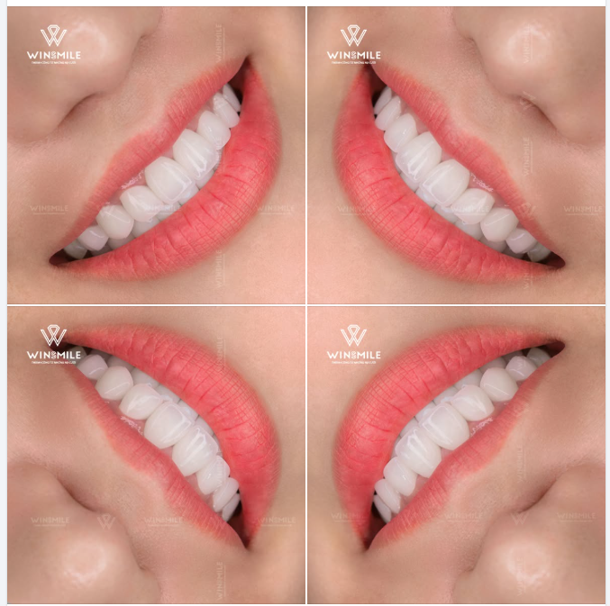 Một nụ cười đẹp là khi từng đường nét đều hài hòa với gương mặt, đủ tự nhiên để người đối diện chỉ cảm nhận được thần thái cuốn hút và sự tinh tế