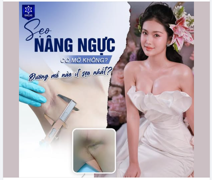 Sẹo nâng ngực là một trong những mối quan tâm hàng đầu của nhiều chị em khi cân nhắc phẫu thuật nâng ngực.