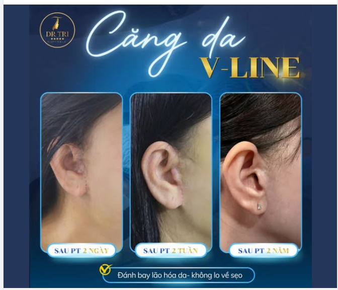 CĂNG DA KHÔNG SẸO TẠI DR. TRÍ
