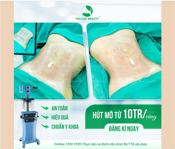 Chi phí hút mỡ của bạn đang được giảm
