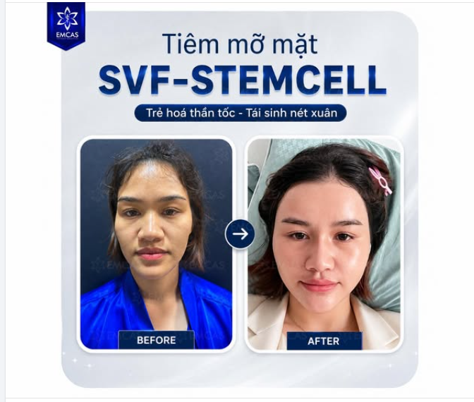 CẤY MỠ SVF-STEMCELL TOÀN MẶT