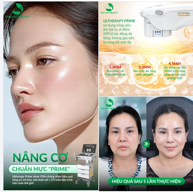 NÂNG CƠ SIÊU TỐC – TRẺ HÓA TỨC THÌ VỚI ULTHERAPY PRIME
