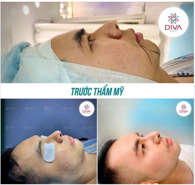 CẢI THIỆN SỐNG MŨI THẤP, CÁNH MŨI TO BÈ VỚI PP NÂNG MŨI TÁI CẤU TRÚC
