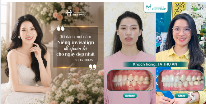 MỘT NĂM NIỀNG INVISALIGN ĐỂ CHUẨN BỊ CHO NGÀY ĐẸP NHẤT