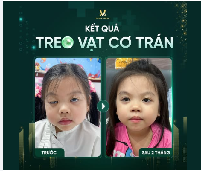 Sự Thay Đổi Sau 2 Tháng PT Sụp Mi Bẩm Sinh Của Bé Quỳnh Anh