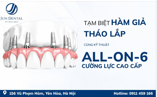 TẠM BIỆT HÀM GIẢ THÁO LẮP – PHỤC HỒI TOÀN HÀM VỚI IMPLANT ALL-ON-6