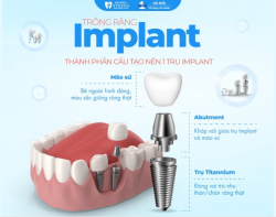 GIẢI MÃ CẤU TẠO CỦA MỘT CHIẾC RĂNG IMPLANT HOÀN CHỈNH