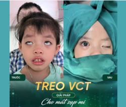 Bé Khánh Linh trước khi đến với Dr. Minh Phạm gặp phảo tình trạng sụp mi mắt phải