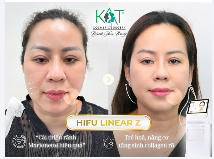 “Rãnh marionette” không chỉ làm mặt già hơn… mà còn kéo toàn bộ gương mặt trông mệt mỏi, chảy xệ dù makeup kỹ đến đâu.