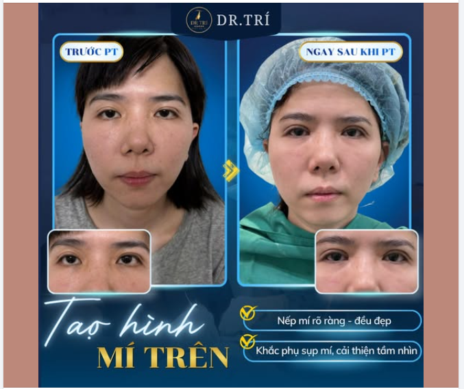 TẠM BIỆT MÍ SỤP – LẤY LẠI ÁNH NHÌN TRẺ TRUNG