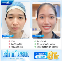 CẮT MÍ EYELID – TỪ 1 MÍ ĐẾN MẮT HAI MÍ TƯƠI TẮN