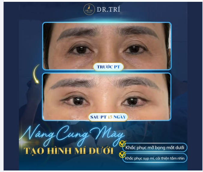 15 NGÀY – NẾP MÍ ĐẸP TỰ NHIÊN NHƯ CHƯA HỀ CHẠM KÉO!