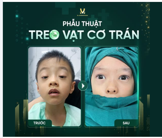 Trường hợp của bé Đức Hiếu: Sụp mi bẩm sinh hai bên mắt ảnh hưởng thẩm mỹ và tầm nhìn