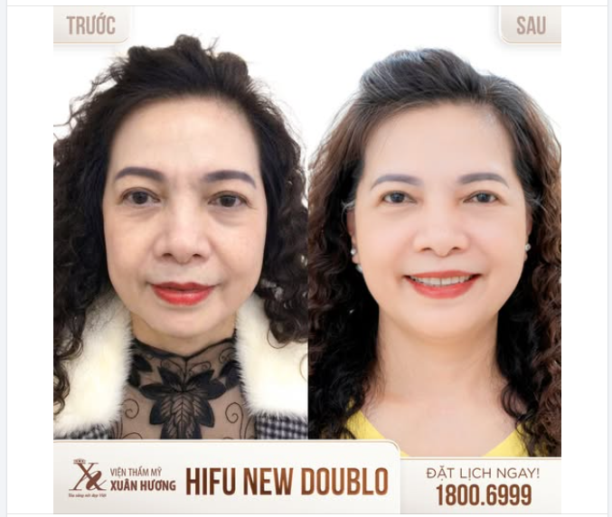 TRẺ HÓA TOÀN DIỆN CÙNG HIFU NEW DOUBLO TẠI VTM XUÂN HƯƠNG